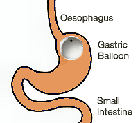 gastric balloon pill in place